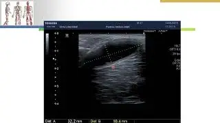 ponction infiltration d'un kyste poplit&eacute;