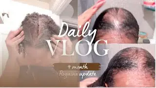 10 Months on Rogaine: My Honest Experience with Female Hair Loss