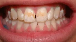 Common Dental Problems: Stains