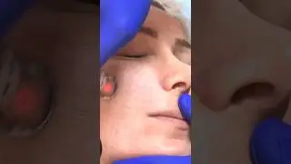 Rejuvenate your skin with Photona laser🥰🥰🥰#shorts #laser #tattoo #photon
