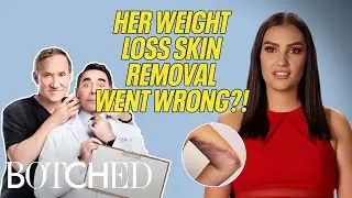 Morgan Lost 120 Pounds and Her Skin Removal Surgery Went Wrong?! (Before & After) | Botched | E!
