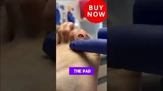 Dr Nail Nipper explainer Corn Pads  #foothealth #footcare #drnailnipper #cornpads #drjillsfootpads