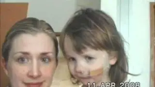 Sunna Valdis Alternating Hemiplegia (AHC) episode Comparison 2008/2011