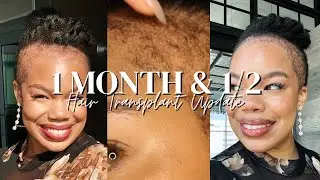1 1/2 Month Update Hair Transplant Post Op 48(Rigged Audio here&there)