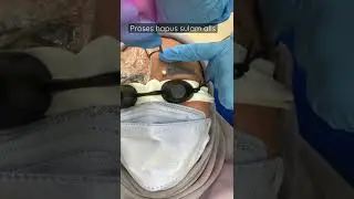 Hapus alis laser tebal tanpa rasa sakit