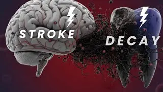 Stroke and tooth decay