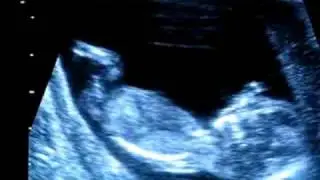 echographie 12 semaines (garcon)