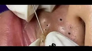Clay Masks for Blackheads &mdash; Real Results Test