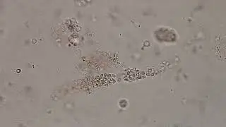 Red blood cells (RBC) Cast in Urine microscopy of renal patient