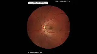 VALSAVA RETINOPATHY - FOLLOW UP #retina #oftalmo #ophthalmology #oftalmologia #oftalmolog&iacute;a #ophtal