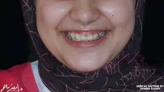 حل الابتسامة اللثوية والناب المدفون بالتقويم impacted canine
