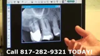 Kyle Eberlein DDS Midcities Dental Explains Why Removing Infections Is Extremely Important