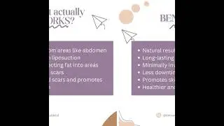 Microfat grafting with stemcells for acne scars by dr bismah bilal