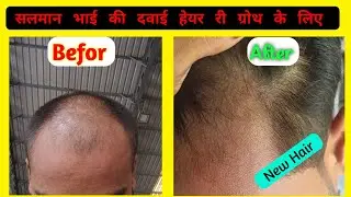Salman Hair Treatment Delhi Side Effects || New Hair regrowth Treatment || Salman bhai online dawai 