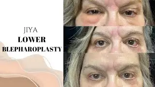 JIYA | PT 1:Lower Blepharoplasty - Canthopexy + Canthoplasty