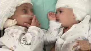 GEMELLE SIAMESI SI GUARDANO PER LA PRIMA VOLTA DALLA NASCITA: INTERVENTO CHIRURGICO DI 12 ORE