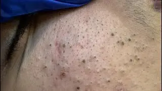 Deep Pore Cleansing Facial Routine | Blackheads Removal & Acne Treatment Solutions