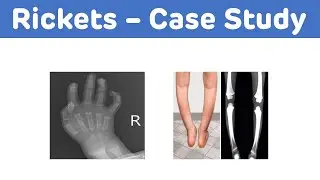 Rickets - Case Study || Rickets || Biochemistry Case Study