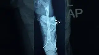 Titanium Elastic Nail System (TENS) #legs #femur #nail #pead #children #baby #fracture #bone#ortho