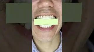ASMR | Japan Melon Gum 🍈 #DoctorTristanPeh #ASMR