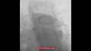 Mother and Child Technique Using STO Catheter during a Trans radial PCI of LCX in Post CABG Patient