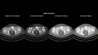 Image-to-Image AI for CT Enhancement