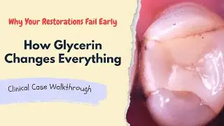 The Glycerin Trick Every Dentist Should Know (No More White Lines!)