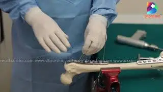 PROXIMAL FEMUR LOCKED PLATE ( LEFT & RIGHT ) Surgical Procedure Demo by DKSORTHO