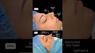 Rhinoplasty Turkey 👃🏼 Dr. Ahmet Dilber ✨ #rhinoplasty #rhinoplastyturkey
