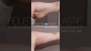 4 patients - 4 excellent arm lift results. #plasticsurgeon #armlifting