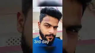 In how many days hijama marks disappears?           #youtubeshorts #hijamacupping #hijamahouse
