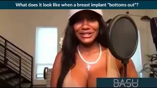 What does it look like when a breast implant &ldquo;bottoms out&rdquo;?
