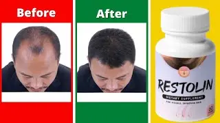 Restolin For Hair Loss | Restolin Hair Growth Review | Restolin Hair  Restolin Hair Before And After