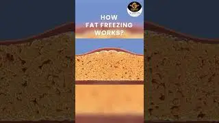 Fat Freezing Treatment by Dr. Salma at The American & U K  Ozonesthetics Clinic