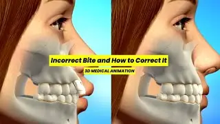 Bad Bite? Top 3 Ways to Fix Crooked Teeth Fast | 3D Dental Animation