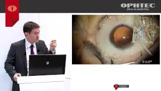 12 months experience with the Precizon Toric intraocular lens
