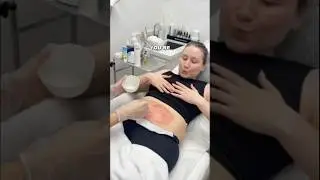 STRETCH MARK REMOVAL TEST pt.1