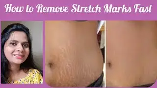 How to get rid of stretch Marks fast. Stretch Marks Treatment at Home.  Effective stretch marks t/t