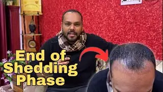 End Of Shedding Phase after Hair Transplant | Day 49 | Vaarun Tiwari #hairtransplant