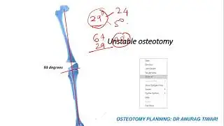 Planificaci&oacute;n de osteotom&iacute;a para genu valgo