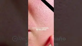 Hollywood Laser Peel #hollywoodpeel #faciales #facial