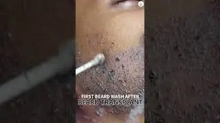 First Beard Hair Wash After Transplant | Post Beard Transplant Care Tips | Care Well Medical Centre
