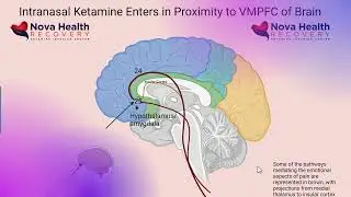 Micro dosing ketamine and ketamine home therapy for depression - Nothing to sneeze at! Does it work?