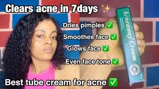 ЧЕСТНЫЙ ОТЗЫВ О КРЕМЕ ACNE AWAY || избавляет от прыщей и угрей за 7 дней ✨🌸