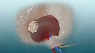 Robot-Assisted Partial Nephrectomy (RAPN): Advanced Surgery for Kidney Tumors and Cancer