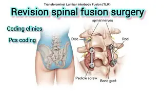 Revision of Lumbar spinal fusion| coding clinics| IP DRG coding 