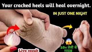 Guaranteed!  Cracked heels will heal in just one night! This magical remedy will make your heels 