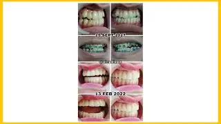 GLOW UP 💖✨ | My Braces Transformation and My Weightloss Journey 🥰🌹❤️ | DienDiana