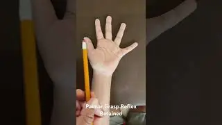 Primitive Reflexes- Palmar Grasp Reflex Retained