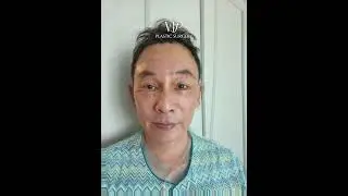 Eye Bags & Forehead Wrinkles Transformation | VIP Plastic Surgery Korea #beforeandafter